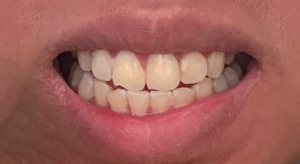 Teeth after 14 days