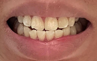 Teeth after 7 days